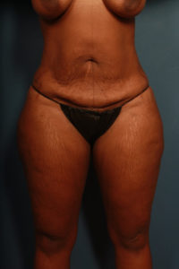 before tummy tuck female patient front view case 2187