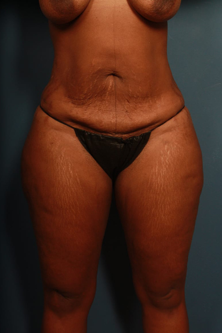 before tummy tuck female patient front view case 2187