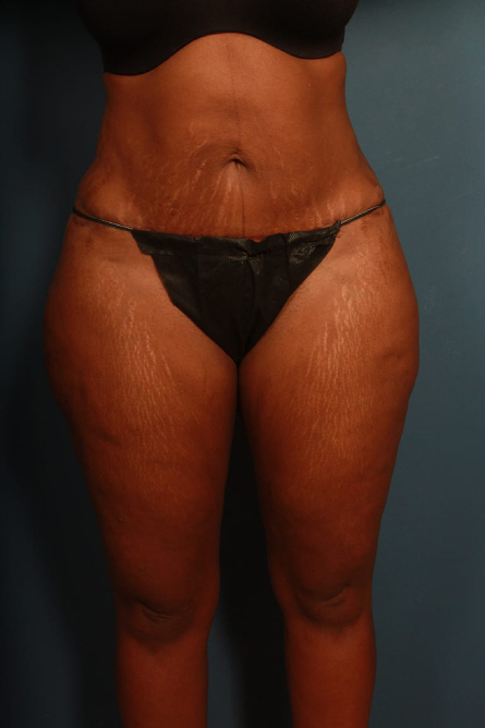 after tummy tuck female patient front view case 2187