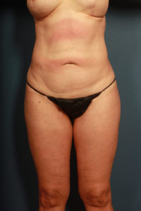 before tummy tuck female patient front view case 2190