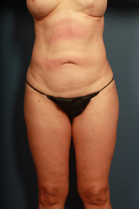 before tummy tuck female patient front view case 2190