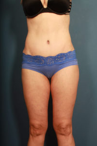 after tummy tuck female patient front view case 2190
