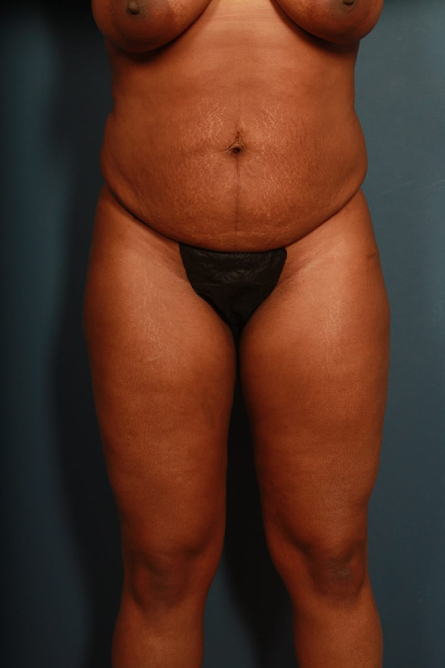before tummy tuck female patient front view case 2193