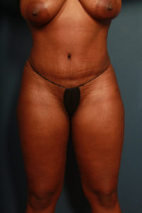 after tummy tuck female patient front view case 2193