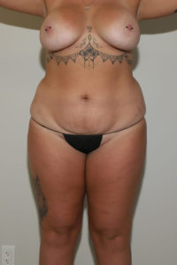 before tummy tuck female patient front view case 2197