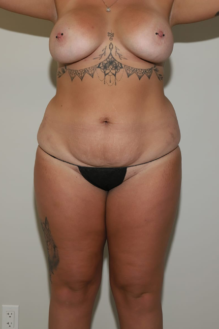 before tummy tuck female patient front view case 2197