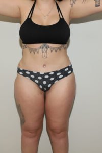 after tummy tuck female patient front view case 2197