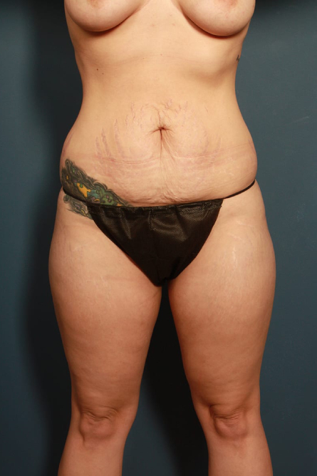 before tummy tuck female patient front view case 2200