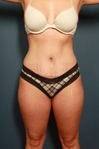 after tummy tuck female patient front view case 2200