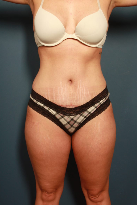 after tummy tuck female patient front view case 2200