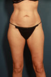 before tummy tuck female patient front view case 2203