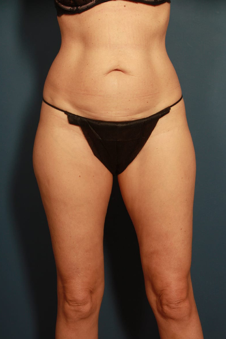 before tummy tuck female patient front view case 2203