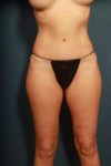 after tummy tuck female patient front view case 2203