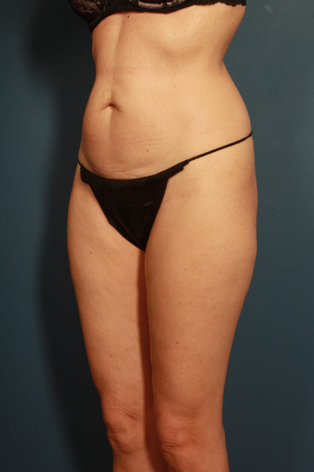 before tummy tuck female patient front angled view case 2203