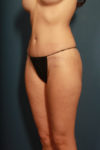 after tummy tuck female patient left angled view case 2203