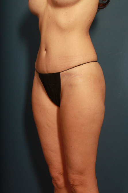 after tummy tuck female patient left angled view case 2203