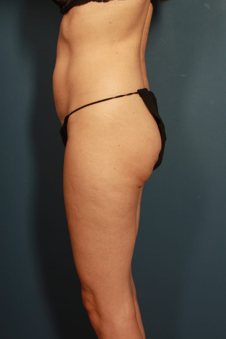 before tummy tuck female patient left side view case 2203