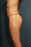 after tummy tuck female patient left side view case 2203