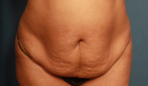 before tummy tuck female patient front view case 1626