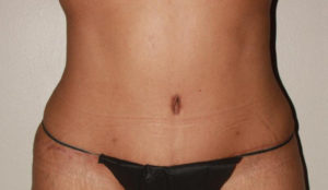 after tummy tuck female patient front view case 1626