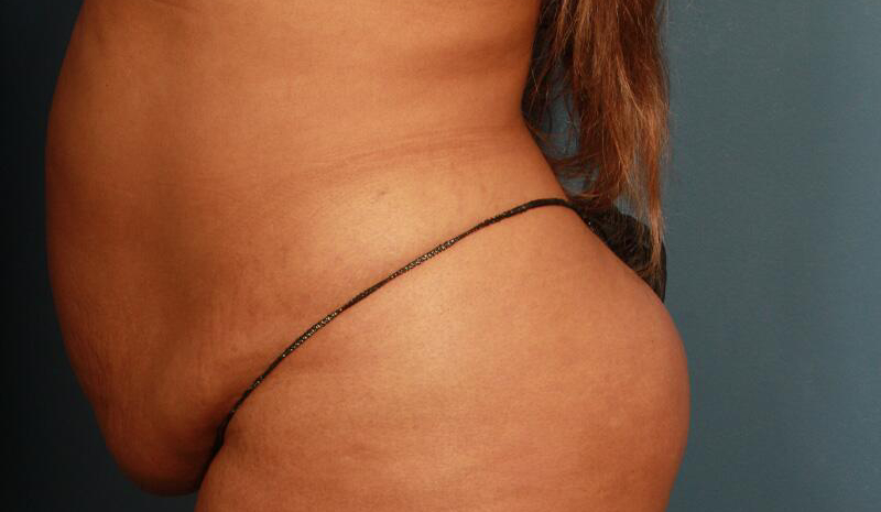 before tummy tuck female patient left side view case 1626