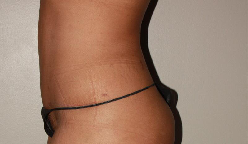 after tummy tuck female patient left side view case 1626