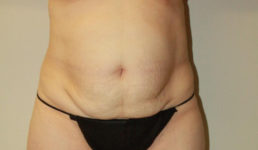 before tummy tuck female patient front view case 2123