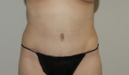after tummy tuck female patient front view case 2123