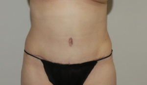 after tummy tuck female patient front view case 2123