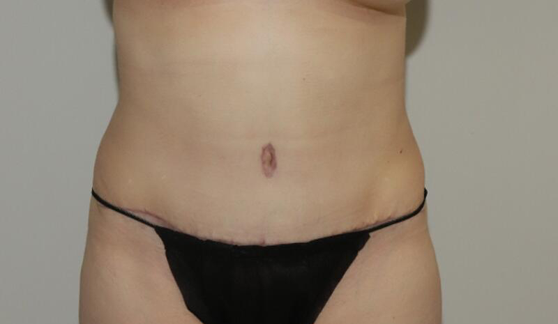 after tummy tuck female patient front view case 2123