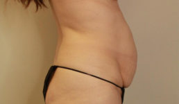 before tummy tuck female patient right side view case 2123