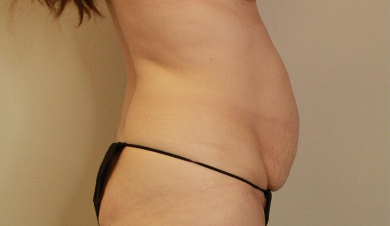 before tummy tuck female patient right side view case 2123