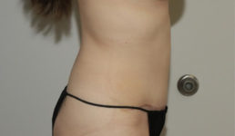 after tummy tuck female patient right side view case 2123
