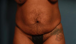 before tummy tuck female patient front view case 2150