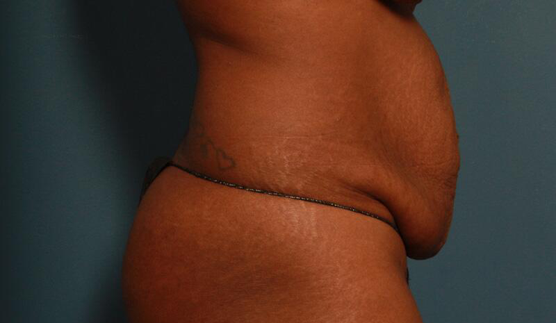 before tummy tuck female patient right side view case 2150