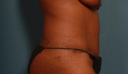 after tummy tuck female patient right side view case 2150