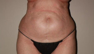 before tummy tuck female patient front view case 2155