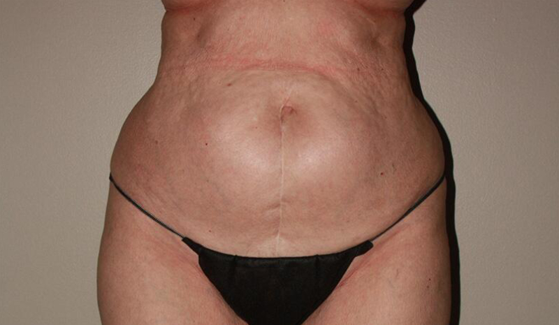 before tummy tuck female patient front view case 2155