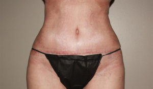 after tummy tuck female patient front view case 2155