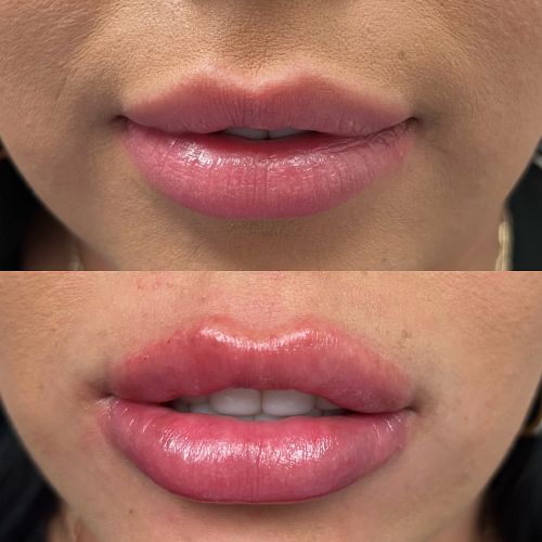 Before and after lip filler front view female patient case 7234