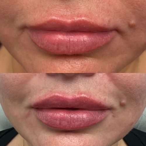 Before and after lip filler front view female patient case 7236