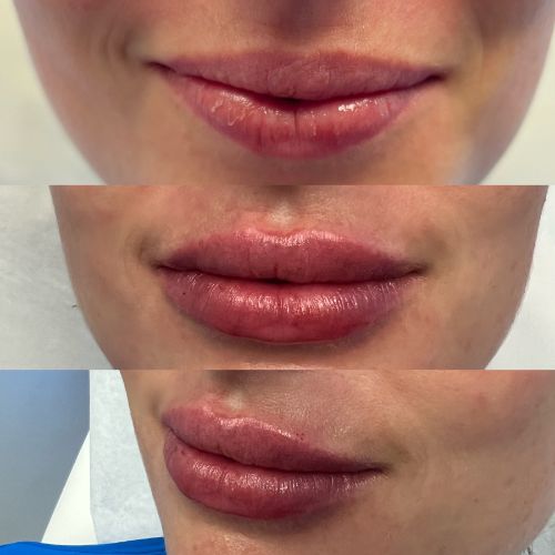 Before and after lip filler front view female patient case 7238